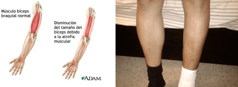 Diagrama de un brazo con músculo normal vs. atrofia muscular, junto a una foto real comparando una pierna sana y otra con pérdida de masa muscular.