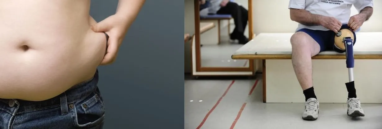 Imagen comparativa que muestra a la izquierda un primer plano de grasa abdominal y a la derecha a un hombre con una prótesis en la pierna, ilustrando la complejidad de la definición de salud y composición corporal.