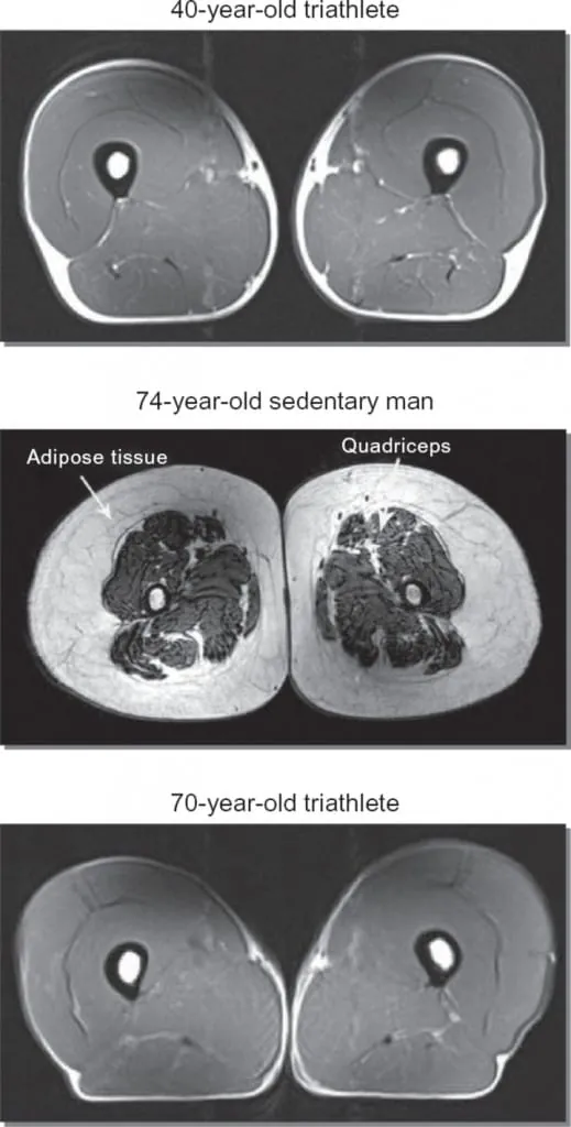 Comparativa de resonancia magnética del muslo entre un triatleta de 40 años, un hombre sedentario de 74 años con sarcopenia y un triatleta de 70 años.