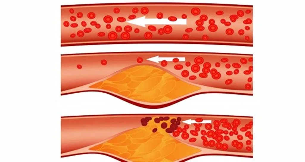 Ilustración médica que muestra las etapas de la aterosclerosis, desde una arteria normal hasta la acumulación de placa de colesterol y la formación de un coágulo.
