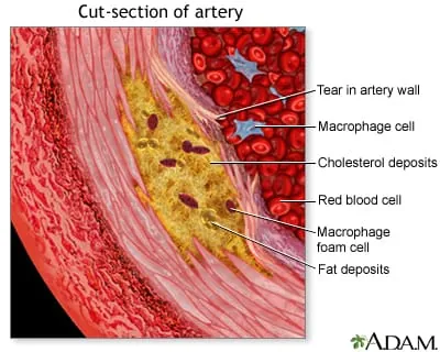 Ilustración médica 3D del interior de un vaso sanguíneo donde se observa una acumulación severa de placa de colesterol (ateroma) obstruyendo el paso de los glóbulos rojos.